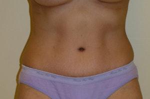 Northside Plastic Surgery tummy tuck after — Alpharetta, GA