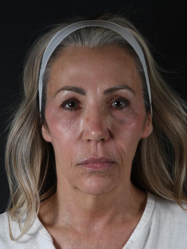 Deep Plane Facelift before at Northside Plastic Surgery in Alpharetta, GA