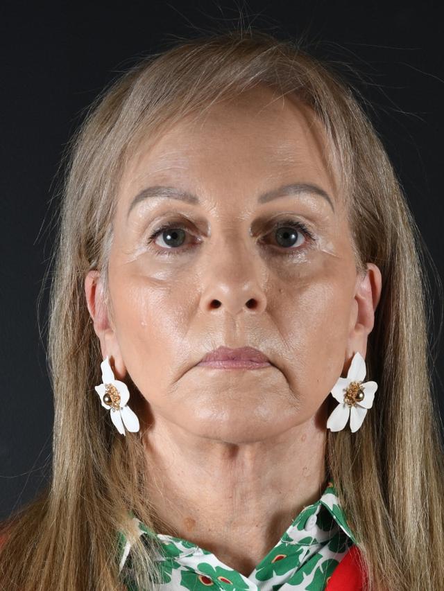 Blepharoplasty after at Northside Plastic Surgery in Alpharetta, GA