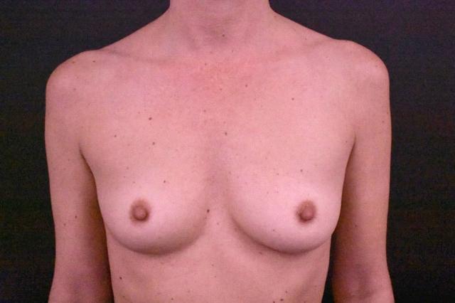 Fat Transfer Breast Augmentation before at Northside Plastic Surgery in Alpharetta, GA