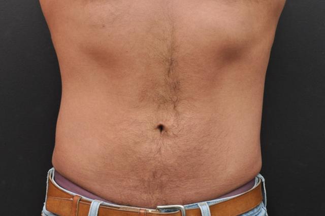 Liposuction before at Northside Plastic Surgery in Alpharetta, GA
