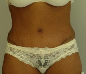 Northside Plastic Surgery tummy tuck after — Alpharetta, GA