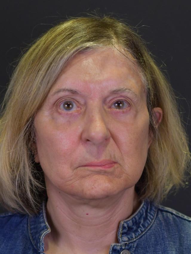 Deep Plane Facelift after at Northside Plastic Surgery in Alpharetta, GA