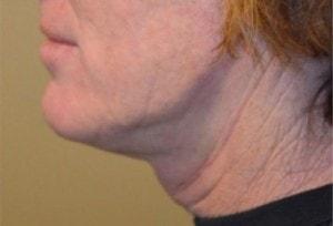 Northside Plastic Surgery neck lift after — Alpharetta, GA