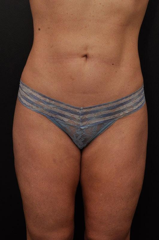 Liposuction after at Northside Plastic Surgery in Alpharetta, GA