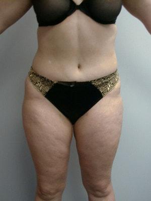 Northside Plastic Surgery tummy tuck after — Alpharetta, GA