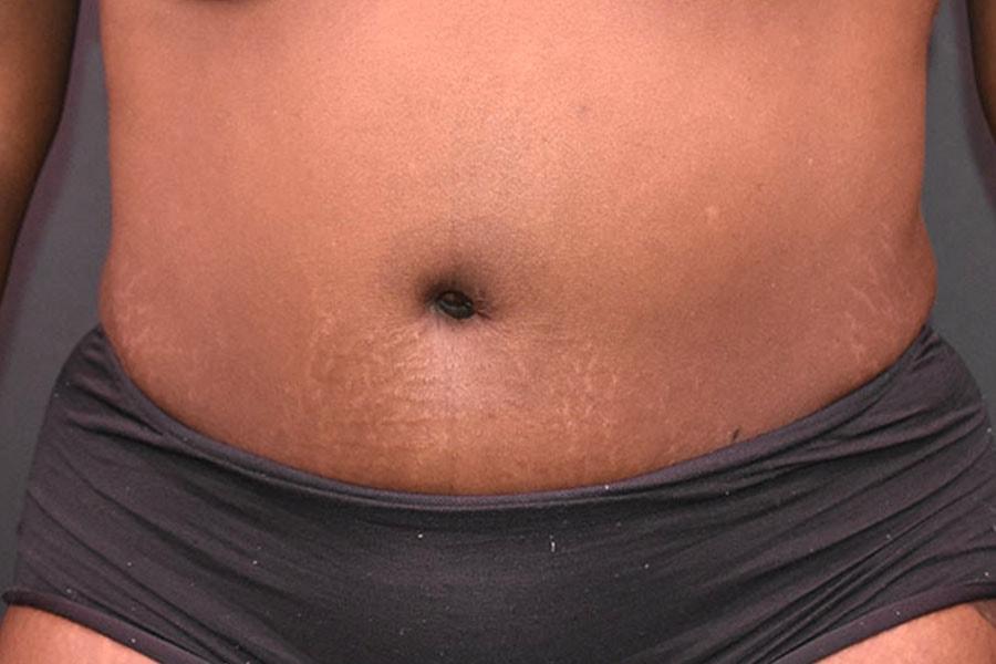 Northside Plastic Surgery tummy tuck after — Alpharetta, GA