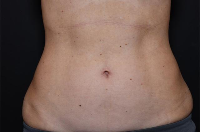 Liposuction before at Northside Plastic Surgery in Alpharetta, GA