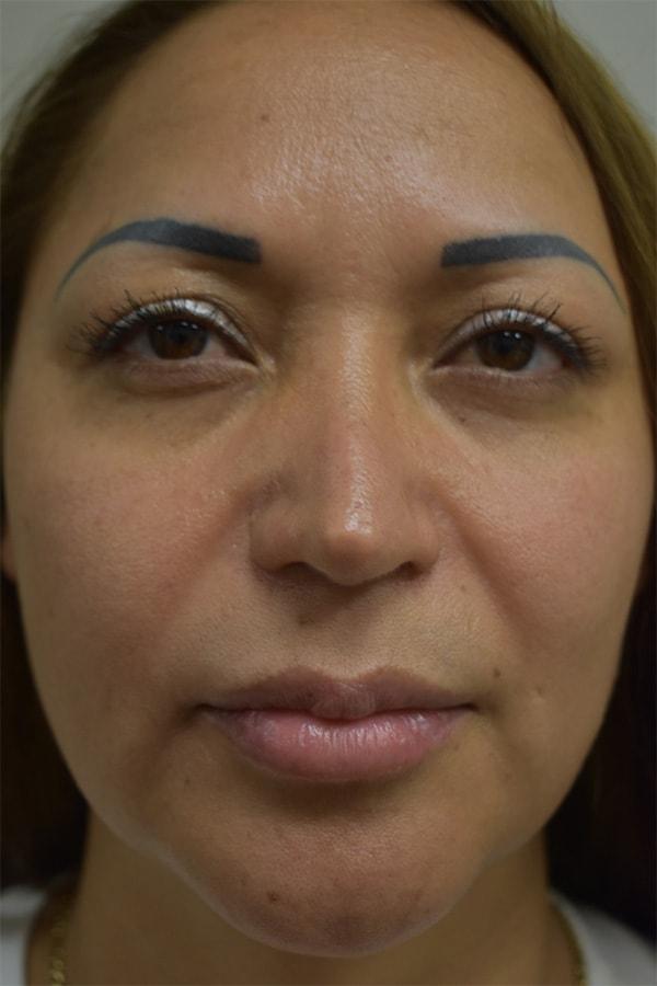 Rhinoplasty before at Northside Plastic Surgery in Alpharetta, GA