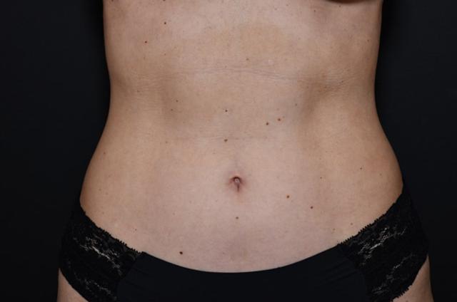 Liposuction after at Northside Plastic Surgery in Alpharetta, GA