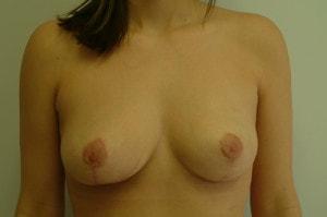 Breast Lift after at Northside Plastic Surgery in Alpharetta, GA