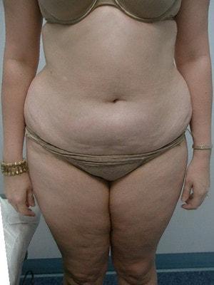 Mini Tummy Tuck before at Northside Plastic Surgery in Alpharetta, GA