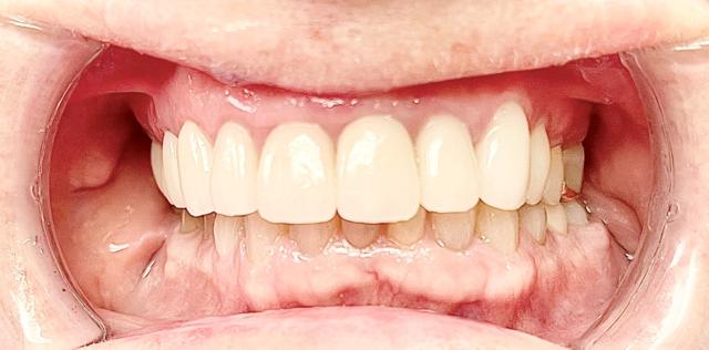Smile Makeover after at Newport Beach Dentistry in Newport Beach, CA