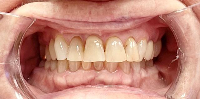 Smile Makeover before at Newport Beach Dentistry in Newport Beach, CA