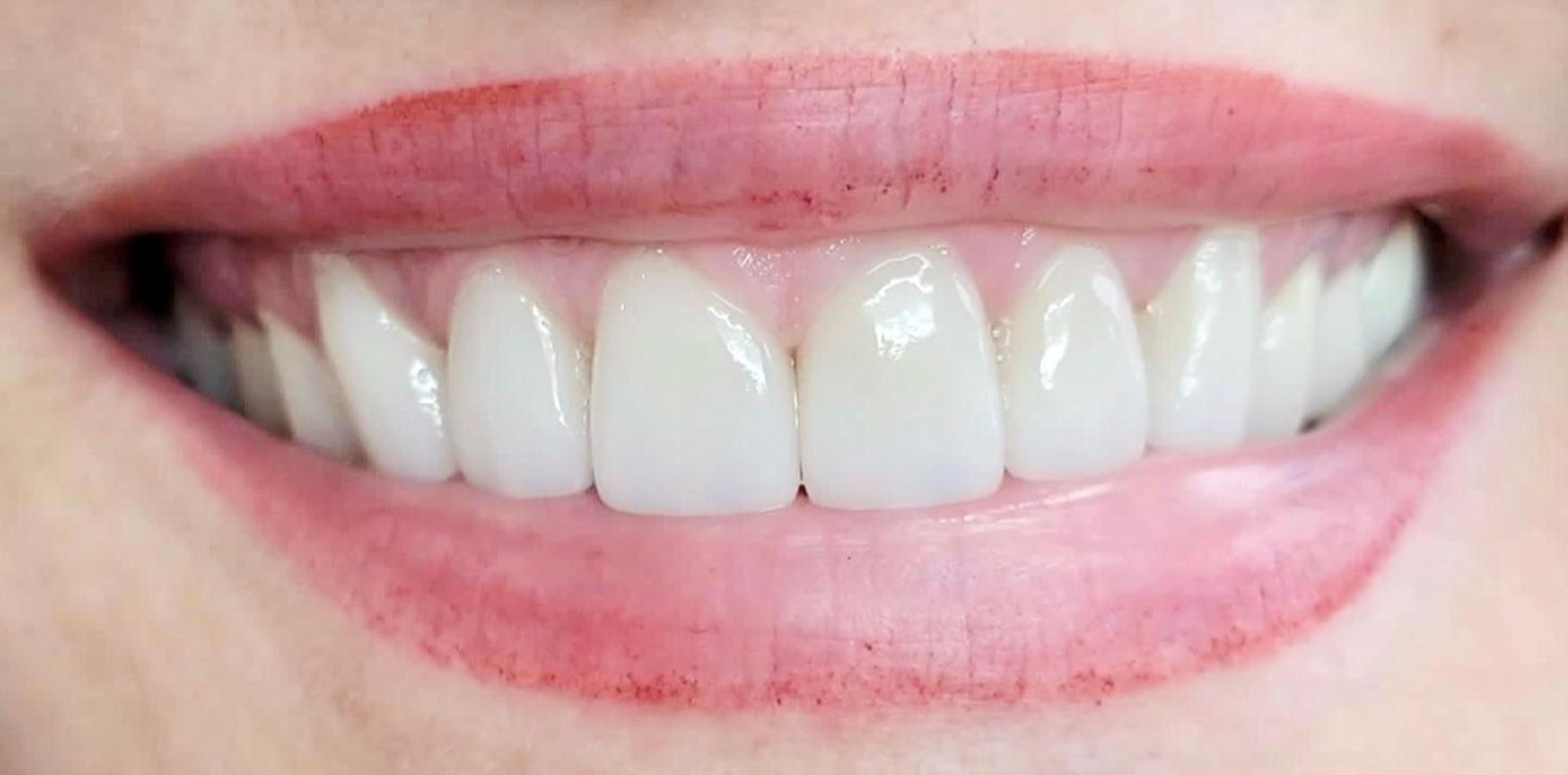 Newport Beach Dentistry smile makeover after — Newport Beach, CA
