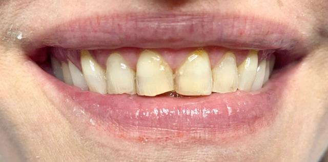 Smile Makeover before at Newport Beach Dentistry in Newport Beach, CA