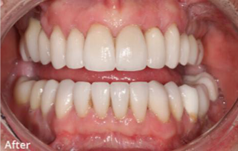 Newport Beach Dentistry smile makeover after — Newport Beach, CA