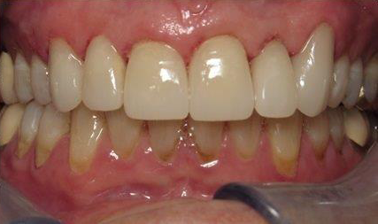 Dental Crowns after at Newport Beach Dentistry in Newport Beach, CA