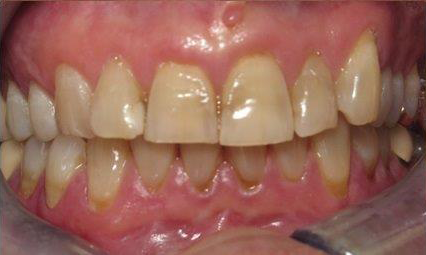 Dental Crowns before at Newport Beach Dentistry in Newport Beach, CA