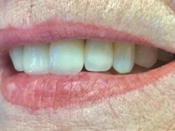 Newport Beach Dentistry smile makeover after — Newport Beach, CA