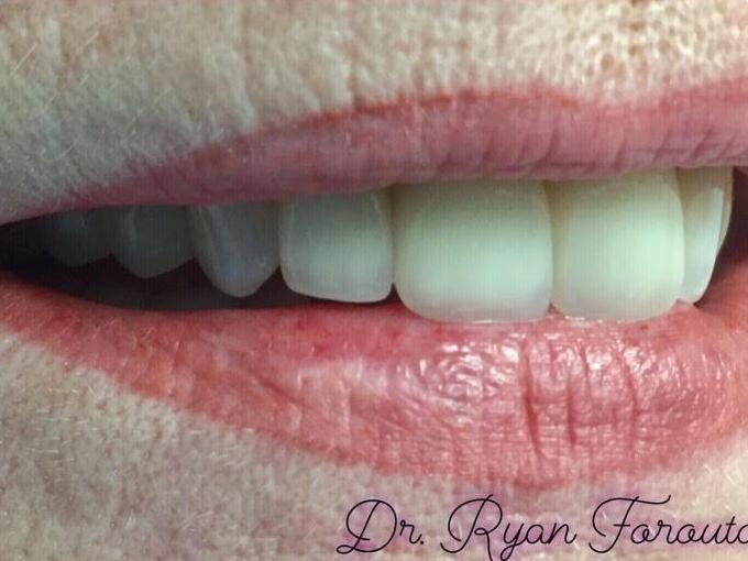Newport Beach Dentistry smile makeover after — Newport Beach, CA