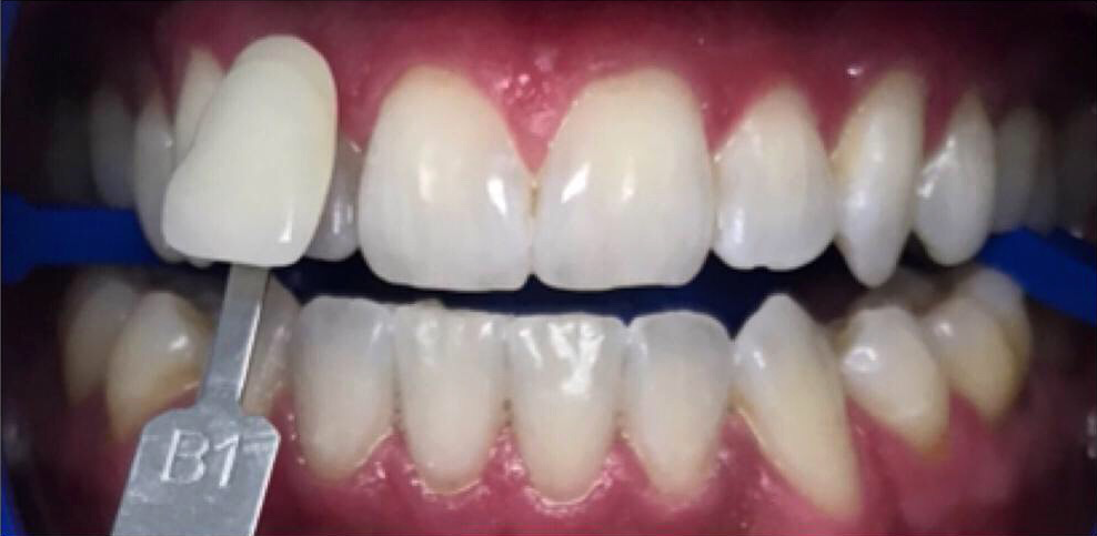 Newport Beach Dentistry teeth whitening after — Newport Beach, CA