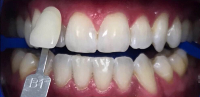 Teeth Whitening after at Newport Beach Dentistry in Newport Beach, CA