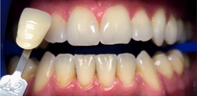 Teeth Whitening before at Newport Beach Dentistry in Newport Beach, CA
