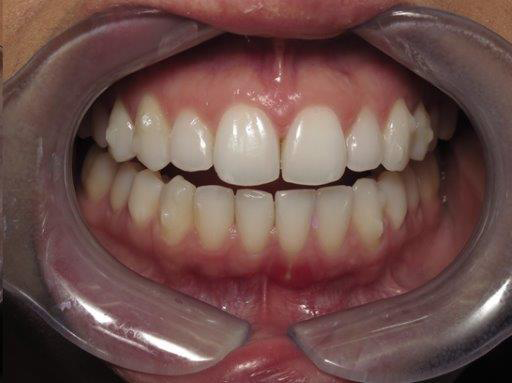 Invisalign after at Newport Beach Dentistry in Newport Beach, CA
