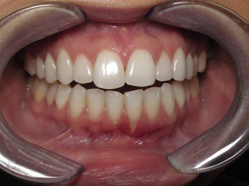 Invisalign before at Newport Beach Dentistry in Newport Beach, CA