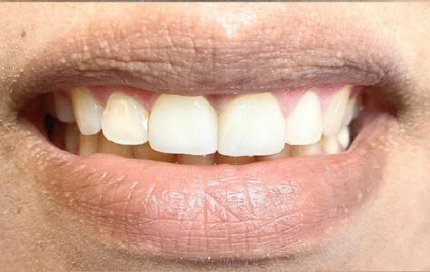Newport Beach Dentistry smile makeover after — Newport Beach, CA