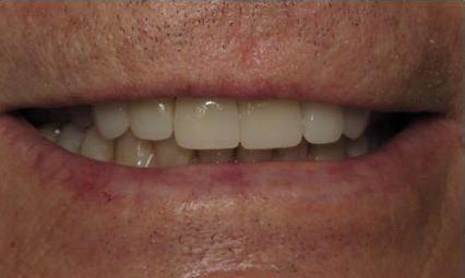 Dental Crowns after at Newport Beach Dentistry in Newport Beach, CA