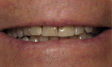 Dental Crowns before at Newport Beach Dentistry in Newport Beach, CA