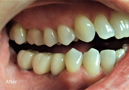 Newport Beach Dentistry smile makeover after — Newport Beach, CA