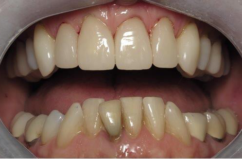 Dental Crowns after at Newport Beach Dentistry in Newport Beach, CA