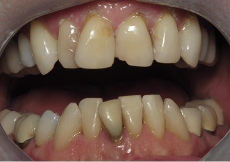 Dental Crowns before at Newport Beach Dentistry in Newport Beach, CA