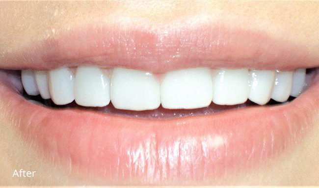 Newport Beach Dentistry dental crowns after — Newport Beach, CA