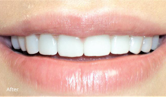 Dental Crowns after at Newport Beach Dentistry in Newport Beach, CA
