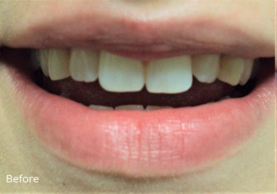 Dental Crowns before at Newport Beach Dentistry in Newport Beach, CA