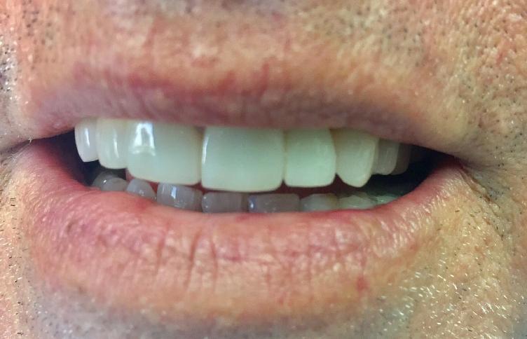 Newport Beach Dentistry smile makeover after — Newport Beach, CA