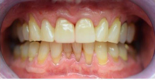 Dental Crowns after at Newport Beach Dentistry in Newport Beach, CA