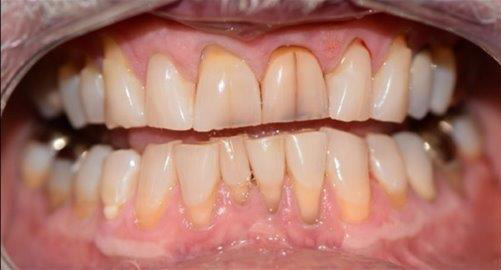 Dental Crowns before at Newport Beach Dentistry in Newport Beach, CA