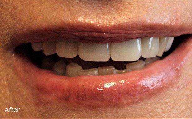 Dental Crowns after at Newport Beach Dentistry in Newport Beach, CA
