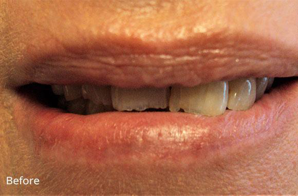 Dental Crowns before at Newport Beach Dentistry in Newport Beach, CA