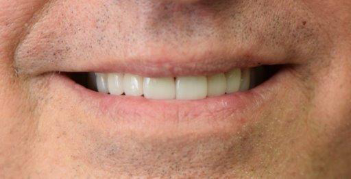 Dental Crowns after at Newport Beach Dentistry in Newport Beach, CA