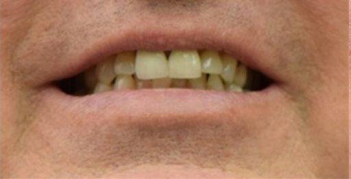 Dental Crowns before at Newport Beach Dentistry in Newport Beach, CA