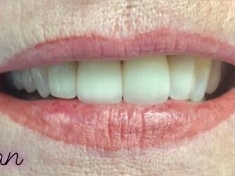 Newport Beach Dentistry smile makeover after — Newport Beach, CA