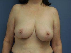 Cynthia M Goodman, MD breast reduction after — Larkspur, CA