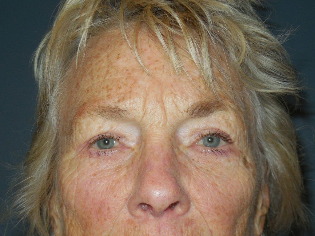 Cynthia M Goodman, MD eyelid lift after — Larkspur, CA