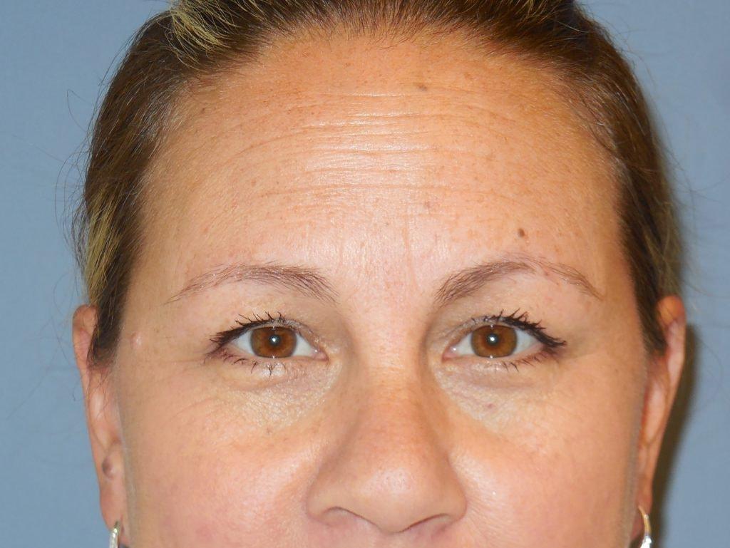 Cynthia M Goodman, MD eyelid lift after — Larkspur, CA